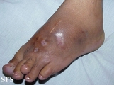 mycetoma