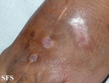 mycetoma
