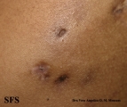 mycetoma