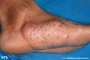 mycetoma