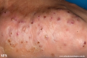 mycetoma