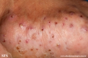 mycetoma