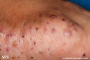 mycetoma