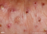 mycetoma