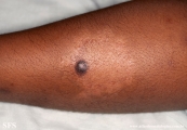 leprosy_tuberculoid_and_dermatofibroma