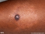 leprosy_tuberculoid_and_dermatofibroma
