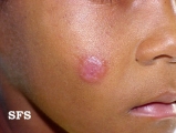 lymphocytoma cutis