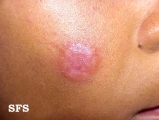 lymphocytoma cutis
