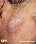 lymphocytoma cutis