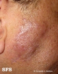 lymphocytoma cutis