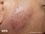 lymphocytoma cutis