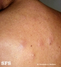 lymphocytoma cutis