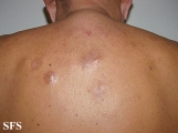 lymphocytoma cutis