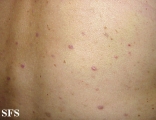 lichen planus-vesicular
