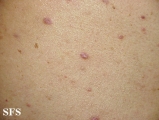 lichen planus-vesicular