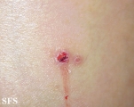 lichen planus-vesicular
