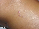 lichen planus-vesicular