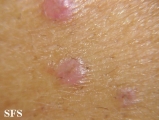 lichen planus-vesicular