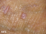 lichen planus-vesicular
