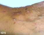 lichen planus-vesicular