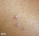 lichen planus-vesicular
