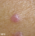 lichen planus-vesicular