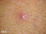 lichen planus-vesicular