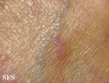 lichen planus-vesicular