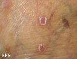lichen planus-vesicular