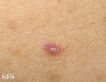 lichen planus-vesicular
