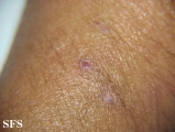 lichen planus-vesicular