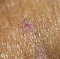 lichen planus-vesicular
