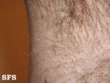 trichomycosis axillaris