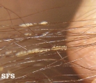 trichomycosis axillaris