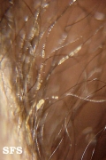 trichomycosis axillaris