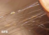 trichomycosis axillaris