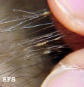 trichomycosis axillaris