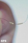 trichomycosis axillaris