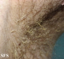 trichomycosis axillaris