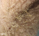 trichomycosis axillaris