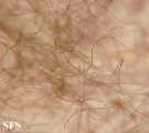 trichomycosis axillaris