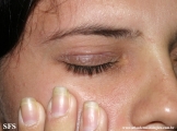 nail polish dermatitis