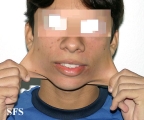 ehlers-danlos syndrome