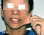 ehlers-danlos syndrome