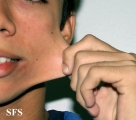 ehlers-danlos syndrome