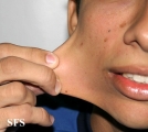 ehlers-danlos syndrome