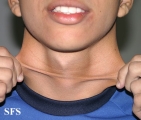 ehlers-danlos syndrome