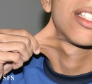 ehlers-danlos syndrome