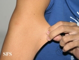 ehlers-danlos syndrome