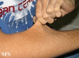 ehlers-danlos syndrome